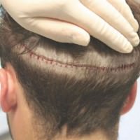 Шрам после трансплантации волос методом FUT