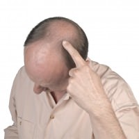 Классический вид выпадения волос – Андрогенная Алопеция