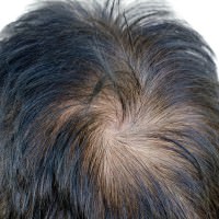 Единственный метод лечения выпадения волос- это пересадка волос техникой FUE