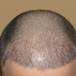 Пересадка Волос Отзывы