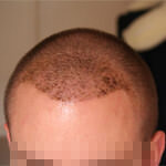 Пересадка Волос Отзывы