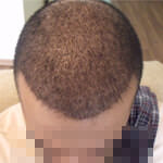 Пересадка Волос Отзывы