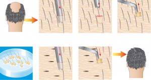 способ проведения процедуры пересадки волос